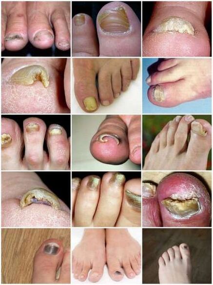 Infekcja grzybicza płytki paznokcia
