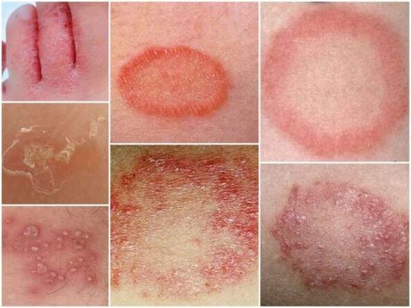 Trichofitoza skóry nóg