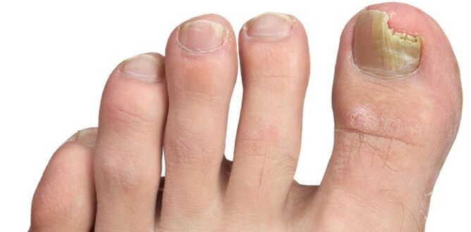 infekcja grzybicza płytki paznokcia